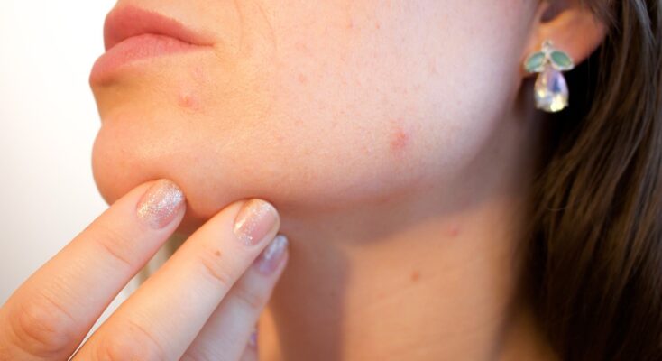 Traitement de l'acné